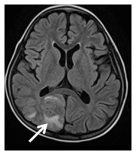 Rare case of cerebral infarction in Congenital Adrenal Hyperplasia: A ...