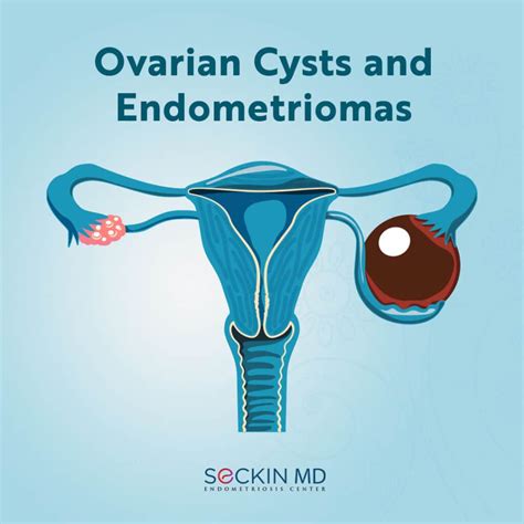 Ovarian Cysts and Endometriomas - Seckin Endometriosis Center