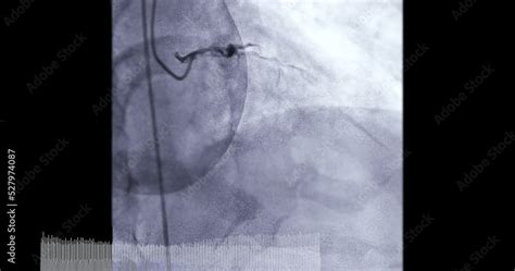 Coronary Angiogram Procedure 的图像结果