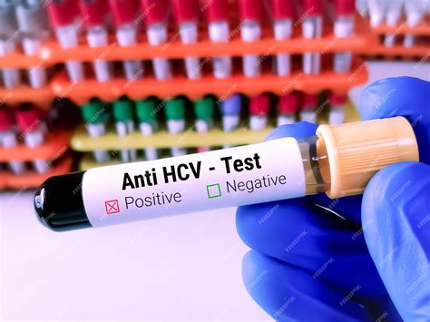 Blood sample for anti hcv test hcv antibody test hepatitis c virus ...