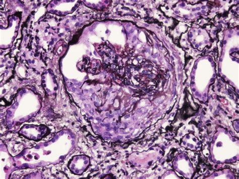 AJKD Atlas of Renal Pathology: Subacute Bacterial Endocarditis ...