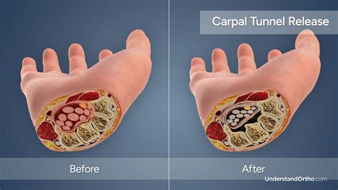Carpal Tunnel Release – UnderstandOrtho™