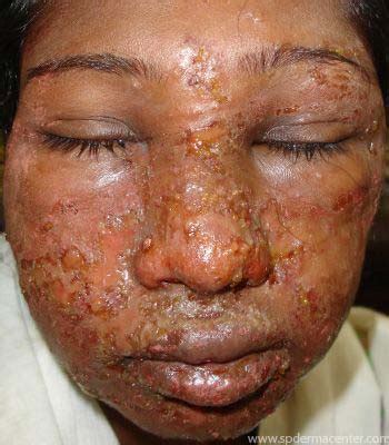 S.P.Derma Center Dermatlogy Cases