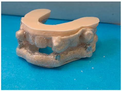 MAMA—Mandibular Advancement Magnetic Appliance: A Digital Workflow and ...