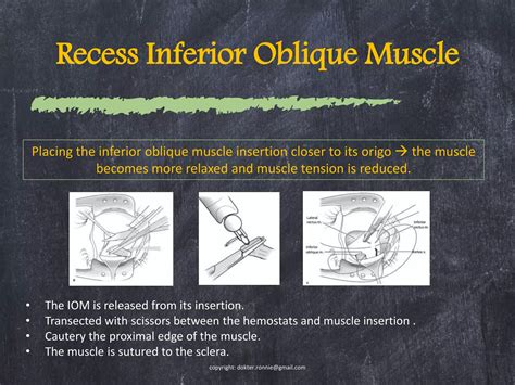 Inferior Oblique Overaction (IOOA) | PPTX