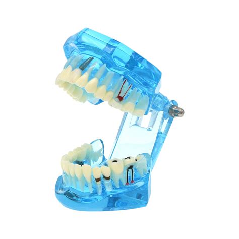 Dental Implant Teeth Model Bridge Restoration | Ubuy India