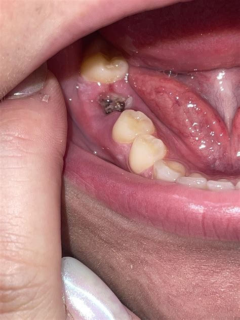Post Tooth Extraction Healing 的图像结果