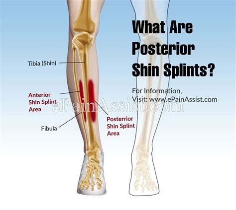 Where Are Shin Splints Located