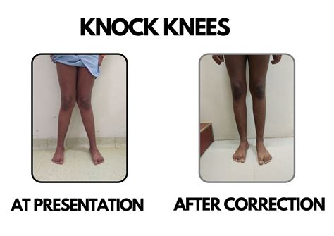 Bowing & Knock Knees :: Dr Deepak khurana- Paediatric Orthopaedic Surgeon