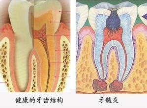 牙髓炎可以自愈吗？牙髓炎牙龈炎牙周炎有什么区别？关于牙髓炎你需要知道的_口腔健康_什么值得买