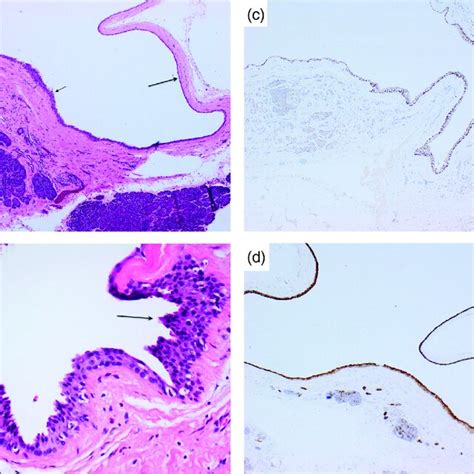 Largest Exploding Cyst 的图像结果