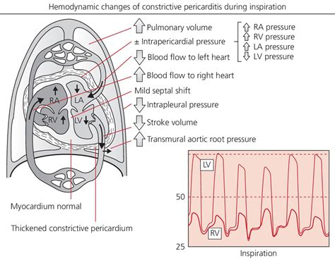 18: Constrictive pericarditis | Thoracic Key
