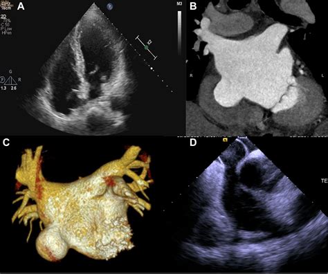 Successful Transseptal Puncture of Giant Atrial Septal Aneurysm With a ...