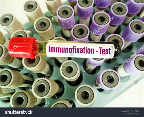 5 Myeloma Serum Protein Electrophoresis Images, Stock Photos & Vectors | Shutterstock