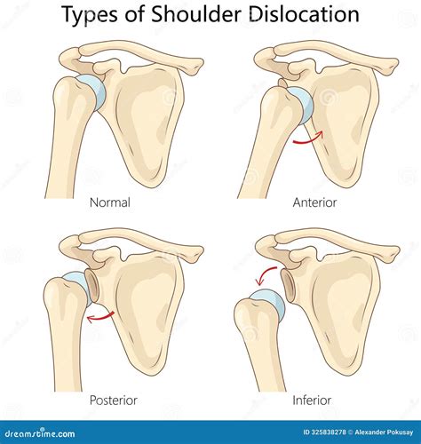 Types Of Shoulder Dislocation Diagram Medical Vector Illustration ...