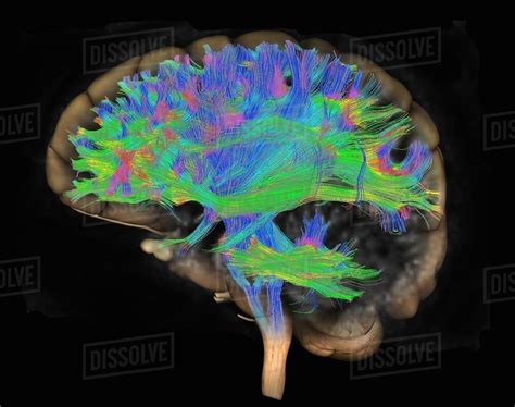 Image result for Diffuse Tensor Imaging