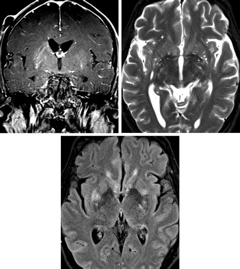 Cryptococcosis | The Neurosurgical Atlas - perivascular space of virchow robin