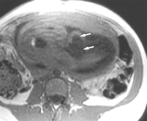 MR Imaging of Umbilical Cord Urachal (Allantoic) Cyst In Utero | AJR