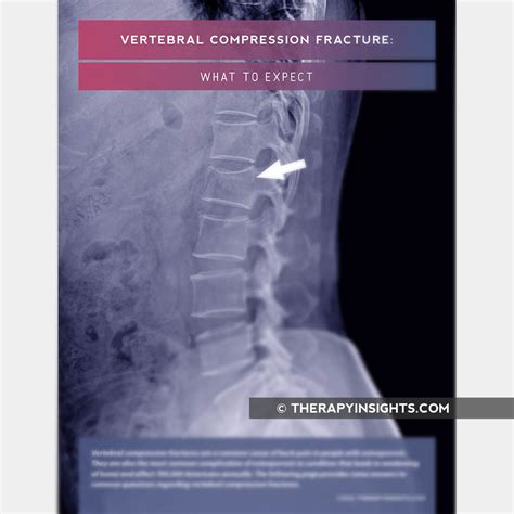 Image result for Compression Fracture Step Defect