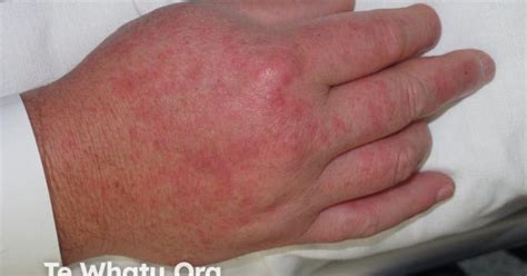 Rash Pictures SJS 的图像结果