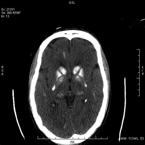 Basal ganglia calcification | BMJ Case Reports