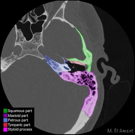 Ct Anatomy Of Temporal Bone Temporal Bone Radiology | SpringerLink