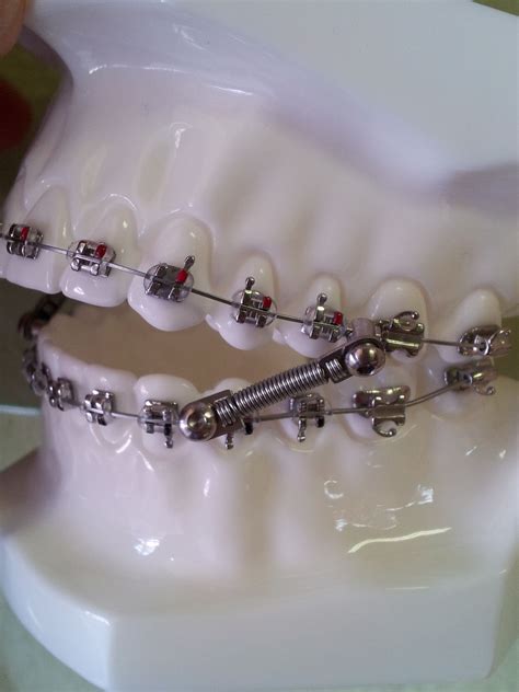 How To Correct Overbite Naturally - Learn Together