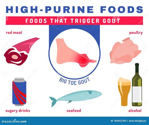 Gout Infographic Poster stock vector. Illustration of doctor - 160052789