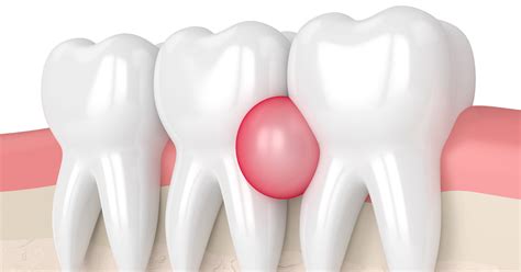 Gum Abscess: Symptoms, Types, Causes & Treatment | Listerine®