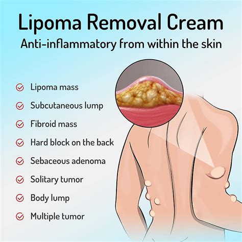 Lipoma Removal Cream 20g - Natural Treatment for Lipoma Care & Discomfort | Buy Now with Express ...
