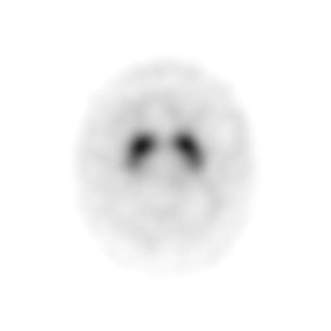 Image result for Normal DaTscan