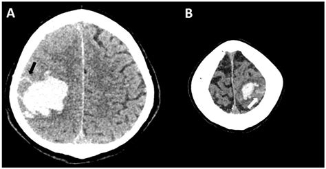 Neuroradiological Findings in Cerebral Amyloid Angiopathy with a ...
