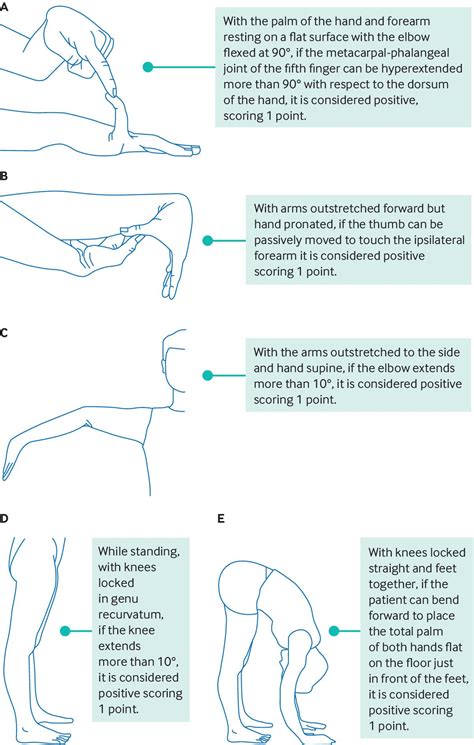 Ehlers-Danlos syndromes | The BMJ