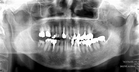 Image result for Tooth Extraction Side Profile