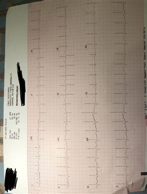 What’s a nonspecific T wave abnormality? Could anxiety cause this? Doc ...