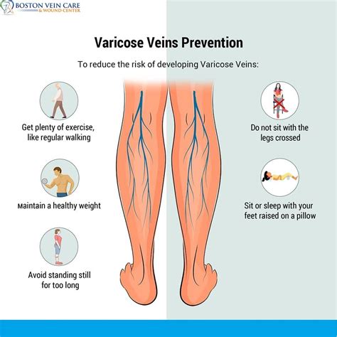 Laparoscopic surgery for varicose veins advantages and disadvantages – Artofit