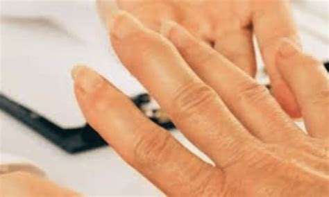 SARD Patients May Exhibit Higher and Prolonged Persistence of COVID-19 ...