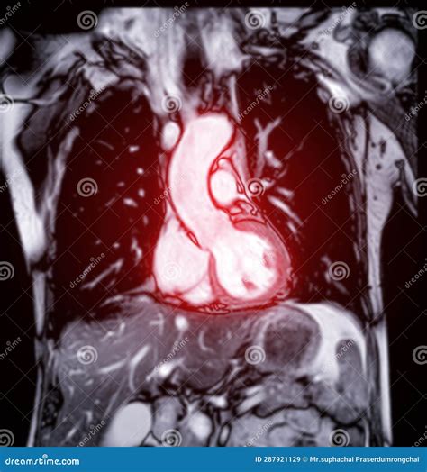 MRI Heart or Cardiac MRI ( Magnetic Resonance Imaging ) of Heart for ...