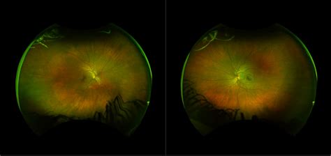 Non-Proliferative Diabetic Retinopathy - Case Study 2
