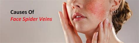 Beyond Skin Deep Dr Jathins Approach To Facial Spider Vei - Health ...