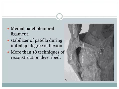 Medial patellofemoral ligament (MPFL) reconstruction | PPTX