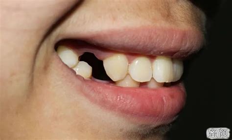 青少年不同发育阶段牙齿的养护方式，中山市牙科门诊专业解答 | 升艺口腔医院