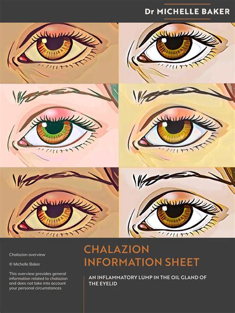 How Does Heat Help Chalazion at Christina Gonzales blog