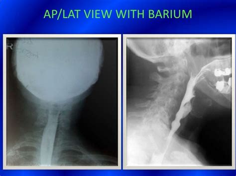 Image result for Modified Barium Swallow Video Example