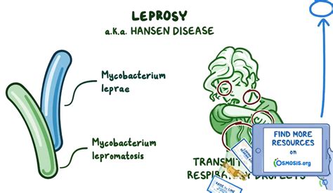 Leprosy How It Spreads