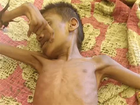 5 children from one family battle rare illness in Rewa: No treatment ...