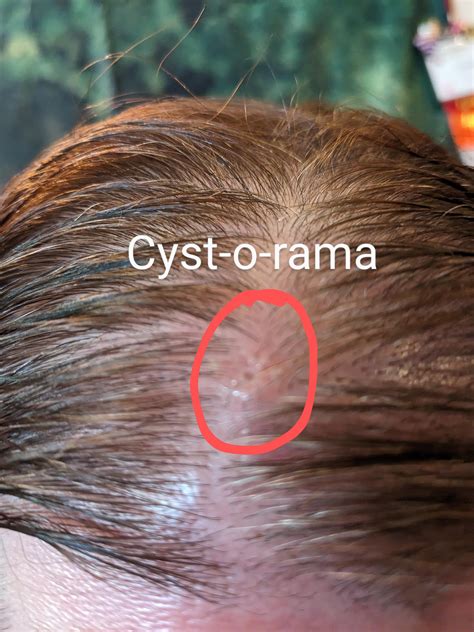 Cyst-o-rama on my head! : r/popping