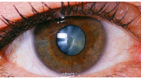 Cataract - safesight eye surgery