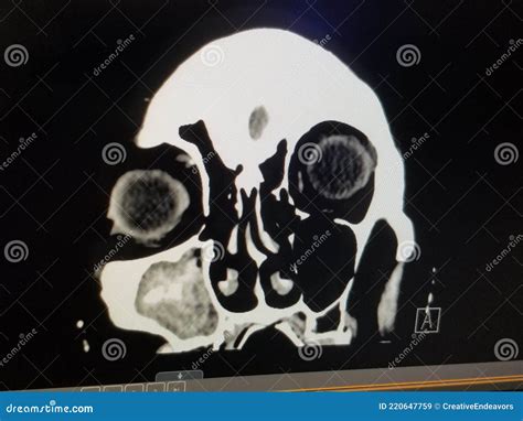 Coronal CT Scan Of The Sinuses And Face - Right Maxillary Sinusitis Royalty-Free Stock Photo ...