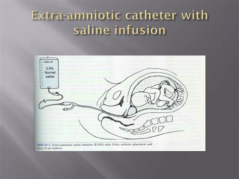 What Is A Foley Catheter Induction Of Labor at Michael Dittmer blog